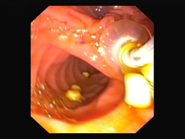 Female presented with pain Abdomen