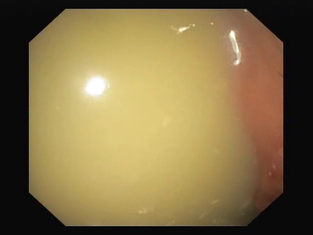 Female presented with pancreatitis