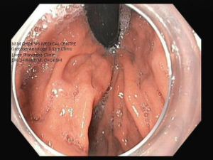 Achalasia Cardia : POEM