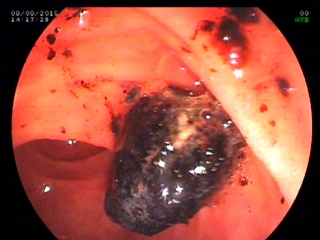 Pain in Abomen with Normal Liver