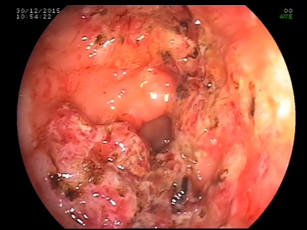 Anemia and Bleeding per Rectum