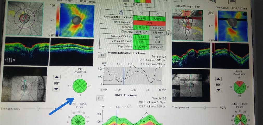 Hypertensive Female with Family History of Glaucoma