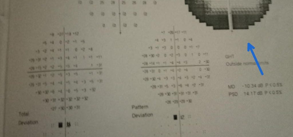 Hypertensive Female with Family History of Glaucoma