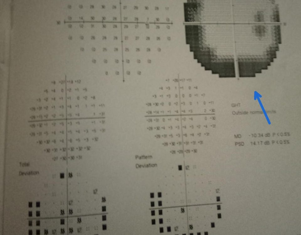 Hypertensive Female with Family History of Glaucoma