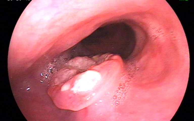 Burning in Upper Parts of Chest