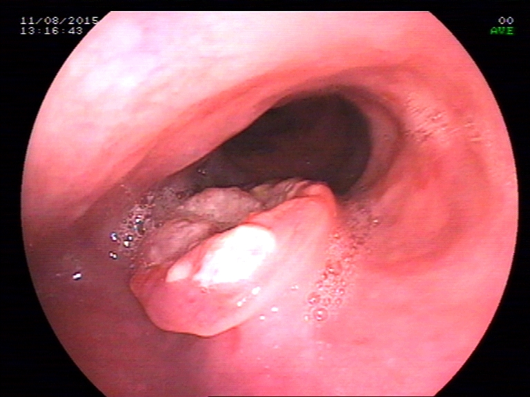 Burning in Upper Parts of Chest