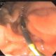 Pancreatic Ductal stricture with Stone