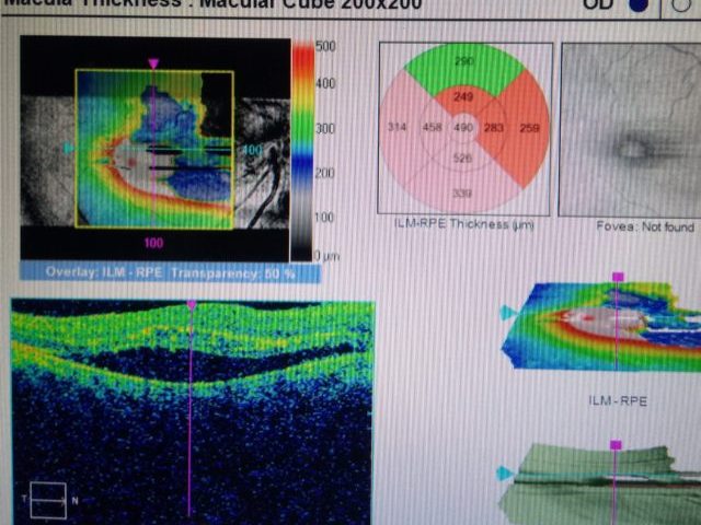 Dimness of vision in right eye since 2 weeks