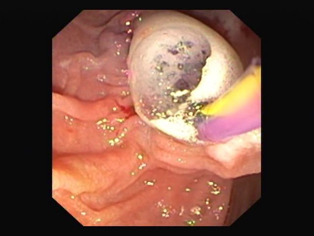 Male presented with pain Abdomen and Jaundice