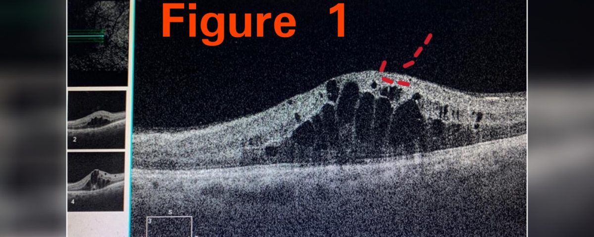 DIABETIC male came with complain of decrease in vision