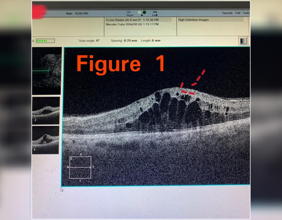 DIABETIC male came with complain of decrease in vision