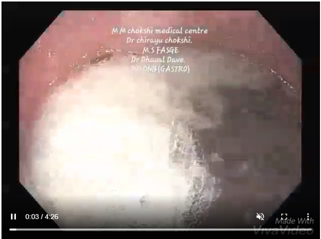 Uploaded ToPer oral endoscopic manometry(POEM)