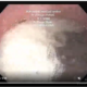 Uploaded ToPer oral endoscopic manometry(POEM)