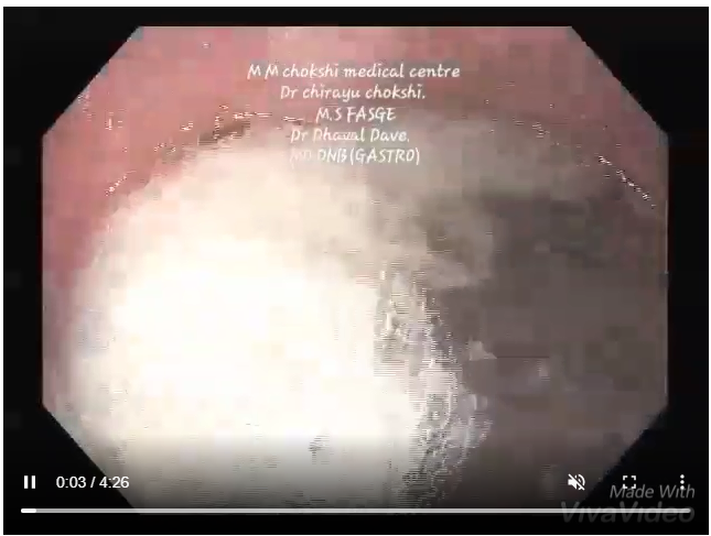 Uploaded ToPer oral endoscopic manometry(POEM)