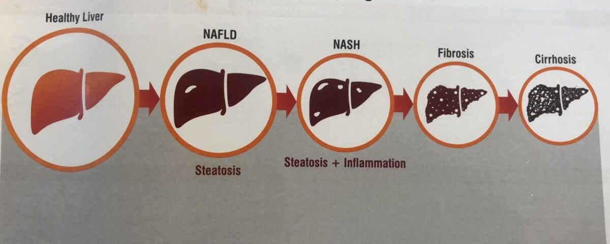 fatty liver