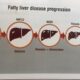 fatty liver