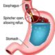 Acid Reflux