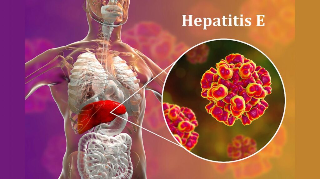 hepatitis E
