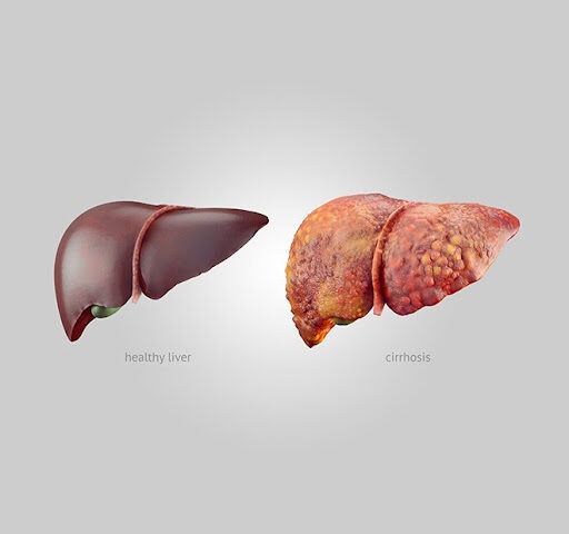 Cirrhosis of the Liver