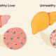 fatty liver