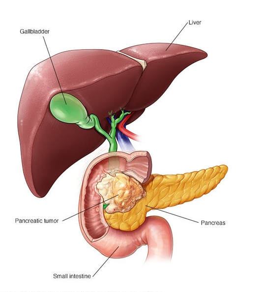 Pancreatic-Ductal-Adenocarcinoma